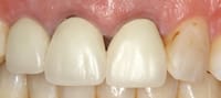 Crowns Information - image 03.02.04-6 on https://www.pyrmontdentalclinic.com.au