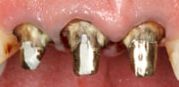 Crowns Information - image 03.02.04-7 on https://www.pyrmontdentalclinic.com.au