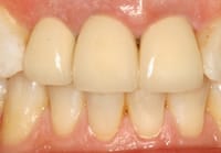 Crowns Information - image 03.02.04-8 on https://www.pyrmontdentalclinic.com.au