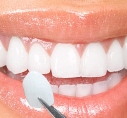 Porcelain Veneers