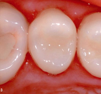 White Fillings